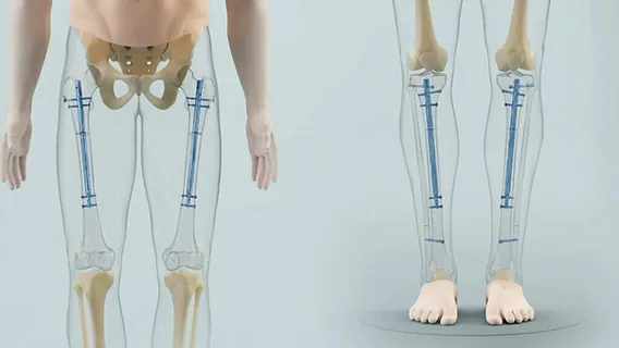 Best Limb Lengthening Surgery in Noida: Comprehensive Guide to Achieving Your Desired Height