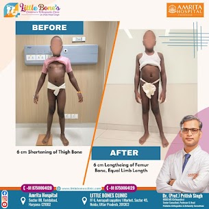 Best Pediatric Orthopedic Surgeon in Faridabad