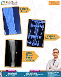 Best Plaster treatment in Greater Noida