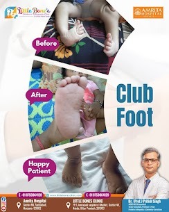 Best Clubfoot Treatment in Greater Noida
