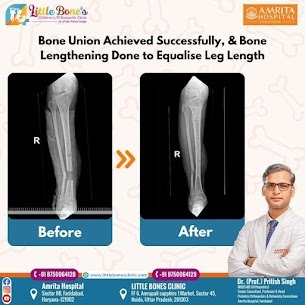 Best Ankle Sprain Treatment in Greater Noida